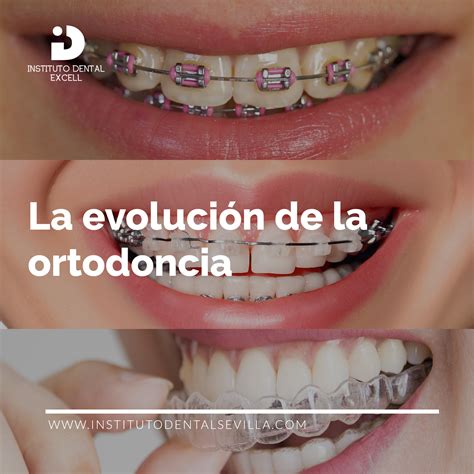 la evolución de los brackets